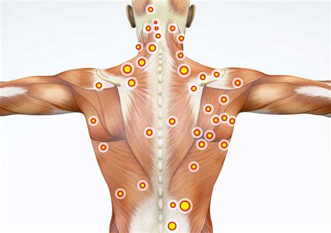 Pain improvement of 50% or. . Trigger point injections